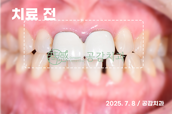 심미치료 전 앞니 정면 사진