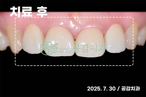 치료 후 Contrast — 조화로운 색상·대칭