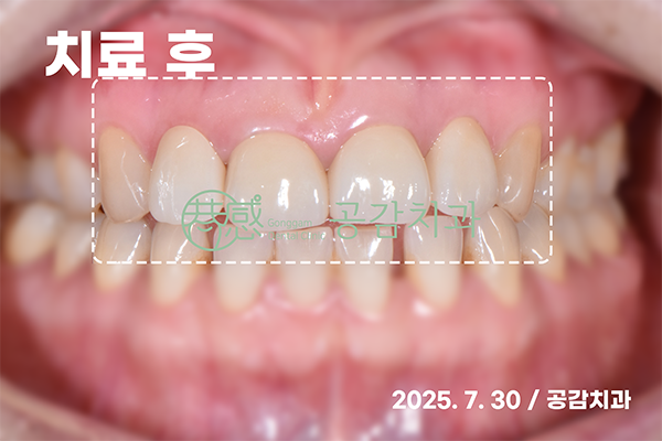 심미치료 후 앞니 정면 사진