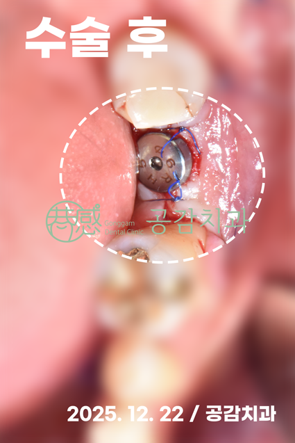 수술 직후: 잔존 치근 발치 후 임플란트 픽스처 식립 및 힐링 어바트먼트 연결 상태