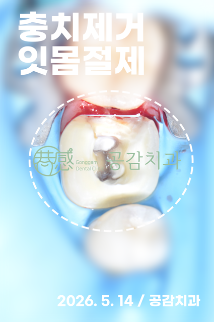 치료 과정 — 충치 제거 및 치은절제
