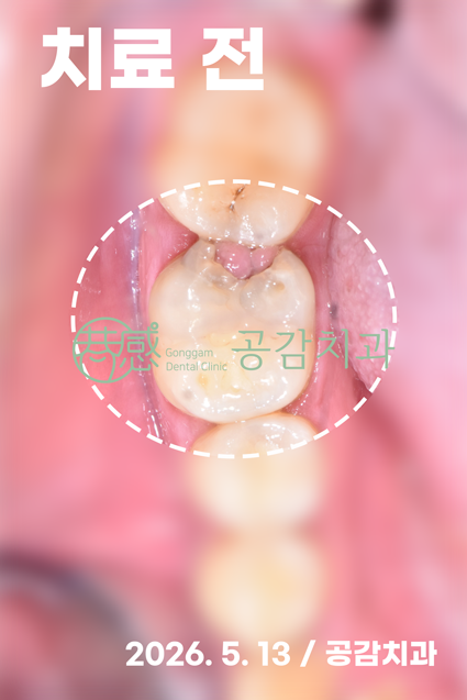 공감치과 자연치아 보존 치료 전 사진