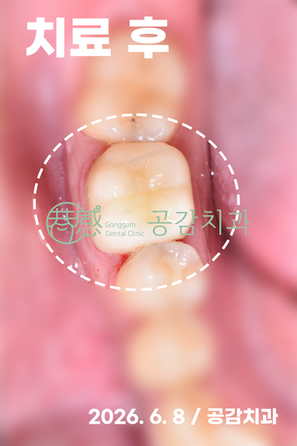 공감치과 자연치아 보존 치료 후 사진